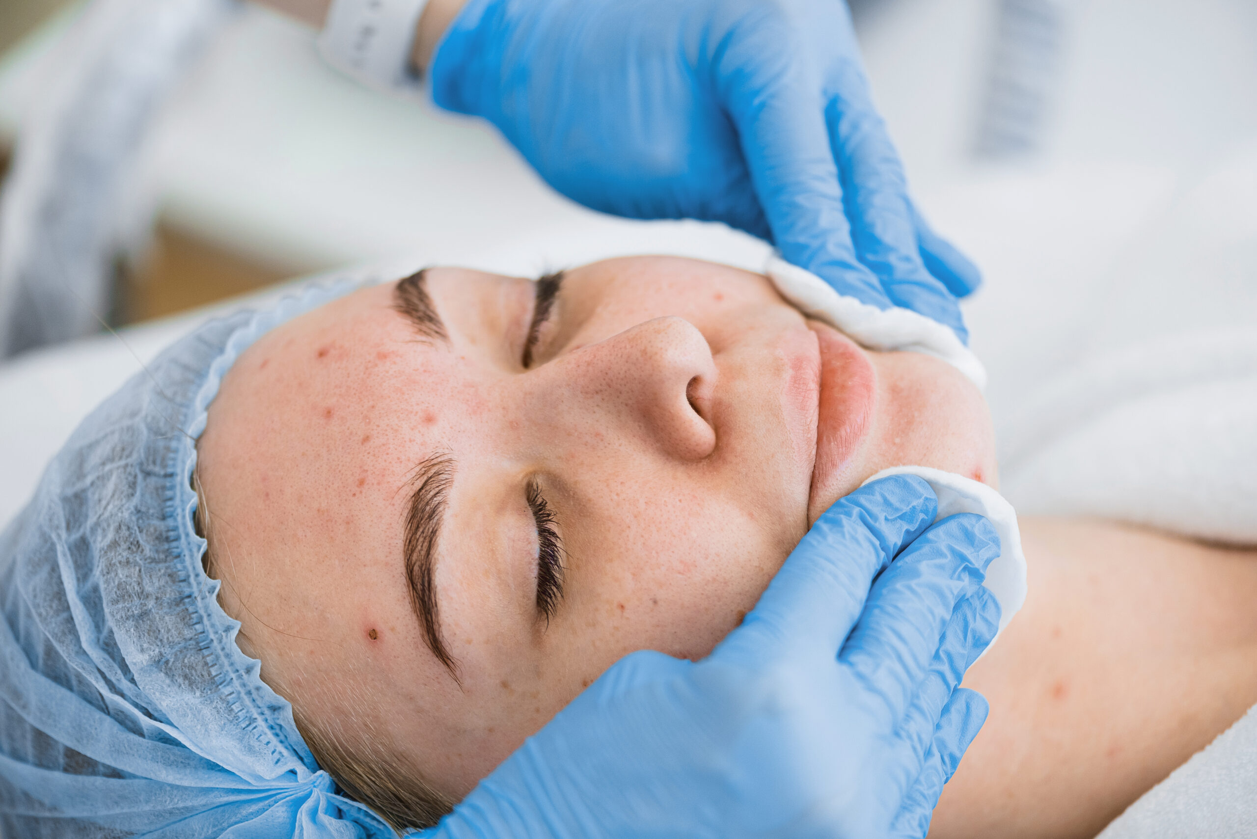 Sponge application of the mask on the face with problem skin