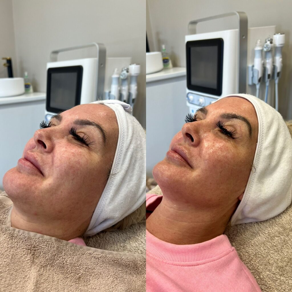 HydraFacial treatment Brentwood