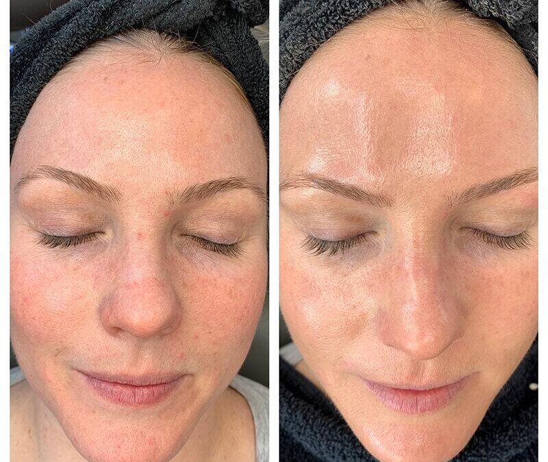 HydraFacial Treatment Brentwood: The Go-To Skin Solution in Essex and Romford