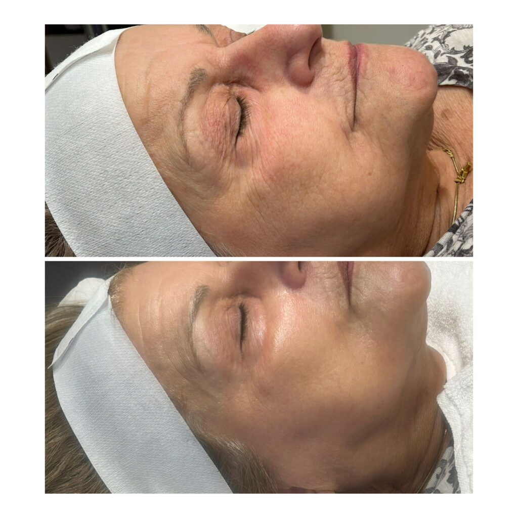 HydraFacial treatment Brentwood
